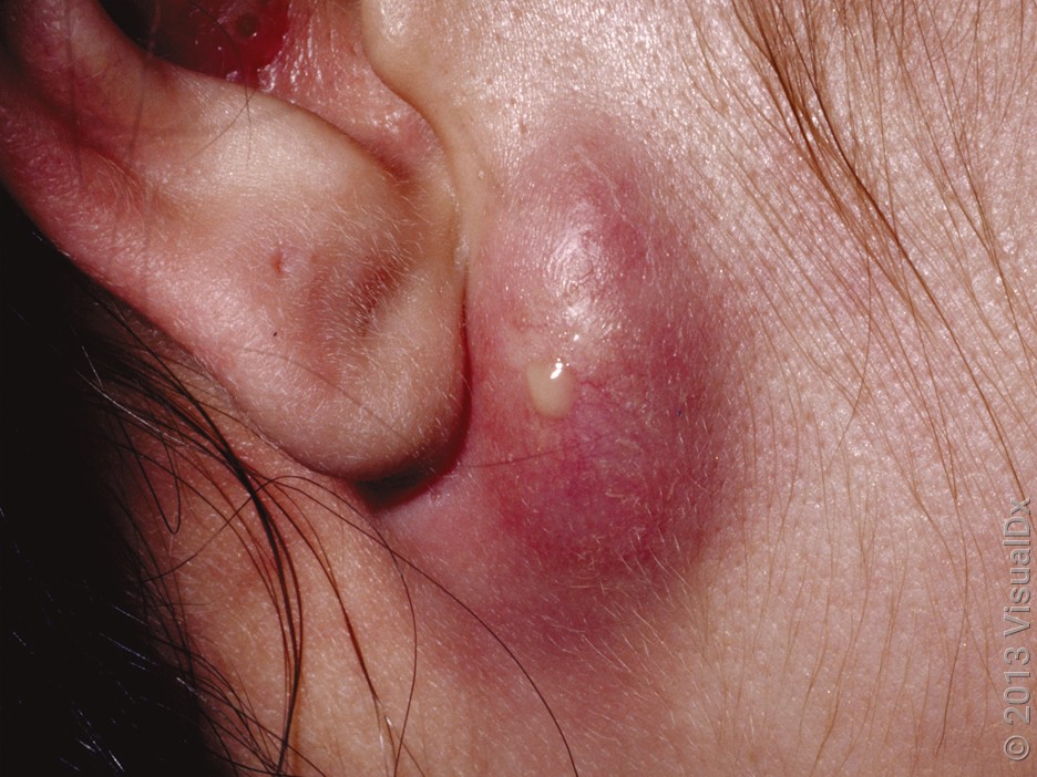 Close-up of an infected sebaceous cyst on the face.