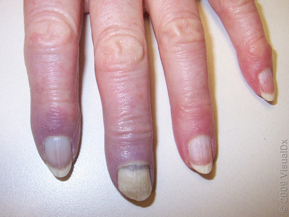 Close-up of Raynaud’s syndrome on fingers.