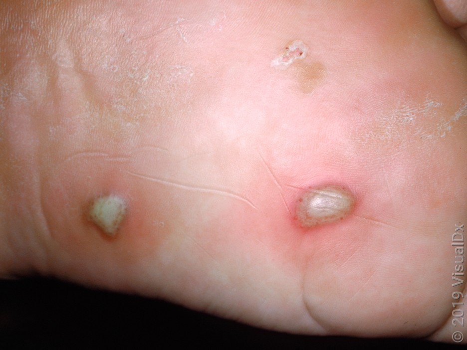 Blisters on the foot caused by athlete’s foot. 