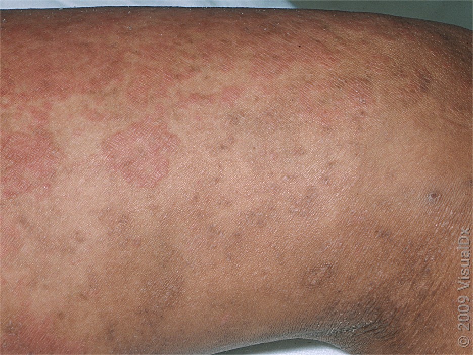 Drug Rashes 7 Medications That Can Cause Skin Reactions Goodrx