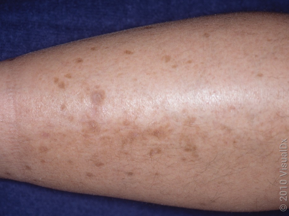 Close-up of diabetic dermopathy on the shin. 