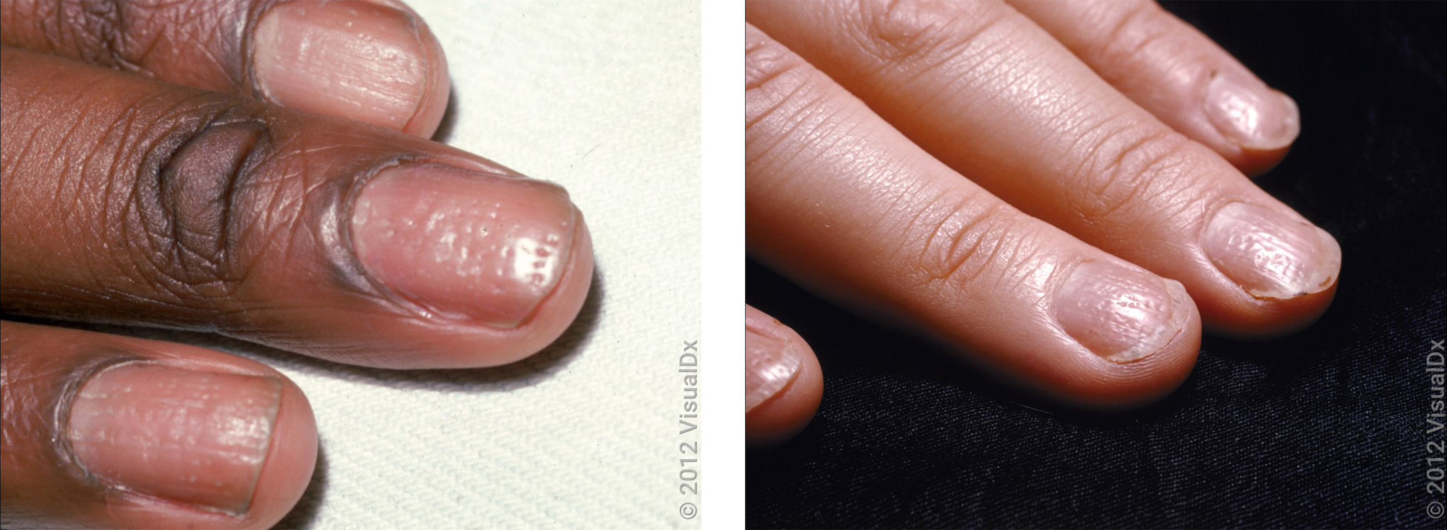 Nails as a Window to Health - LiVDerm