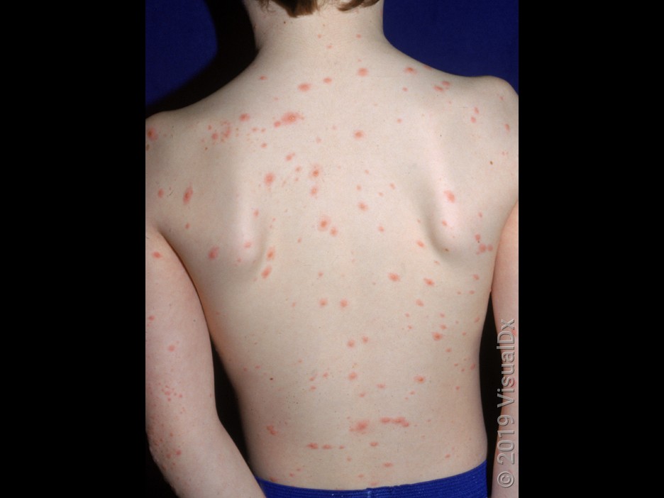 Close-up of chickenpox blisters on the back. 