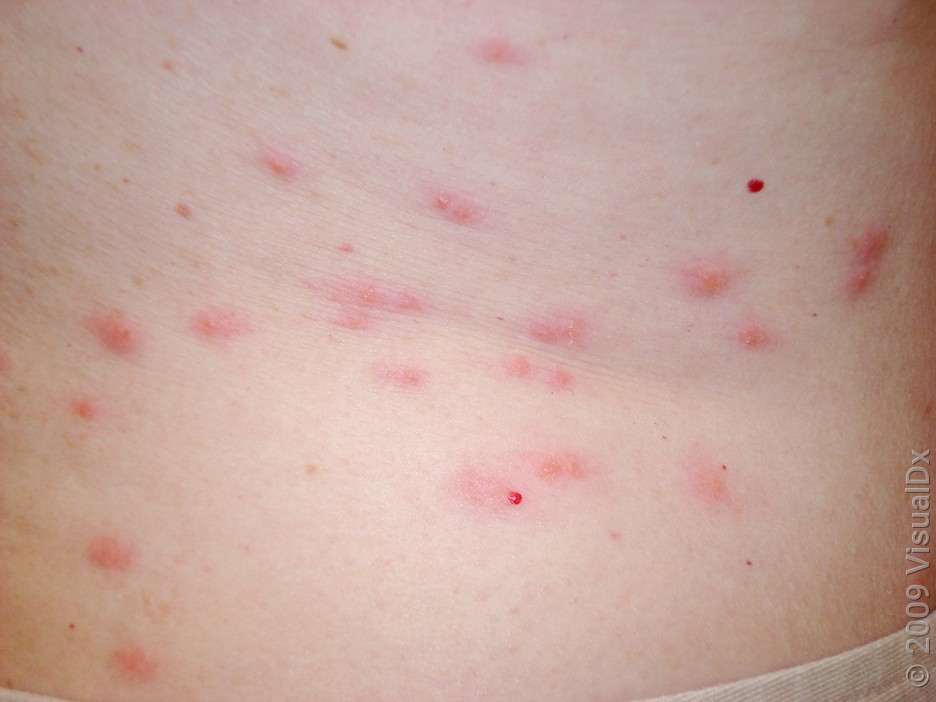 Pink bumps on the lower back from bedbug bites. 