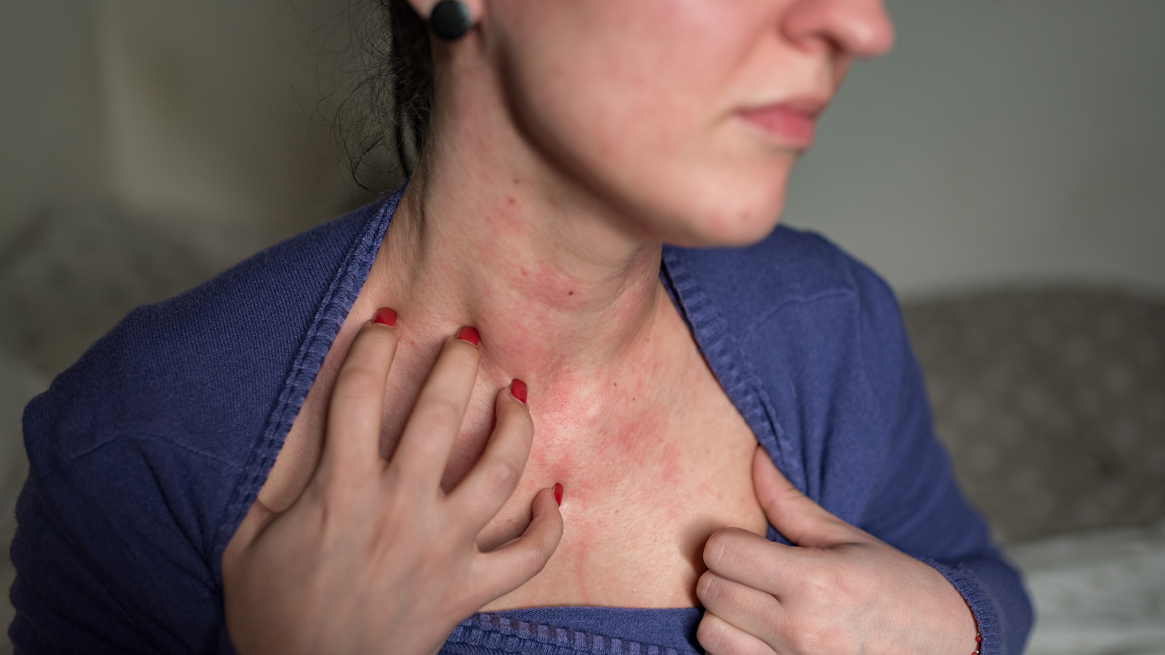 Allergic to Food Coloring? What Food Dye Allergy Symptoms Look Like GoodRx