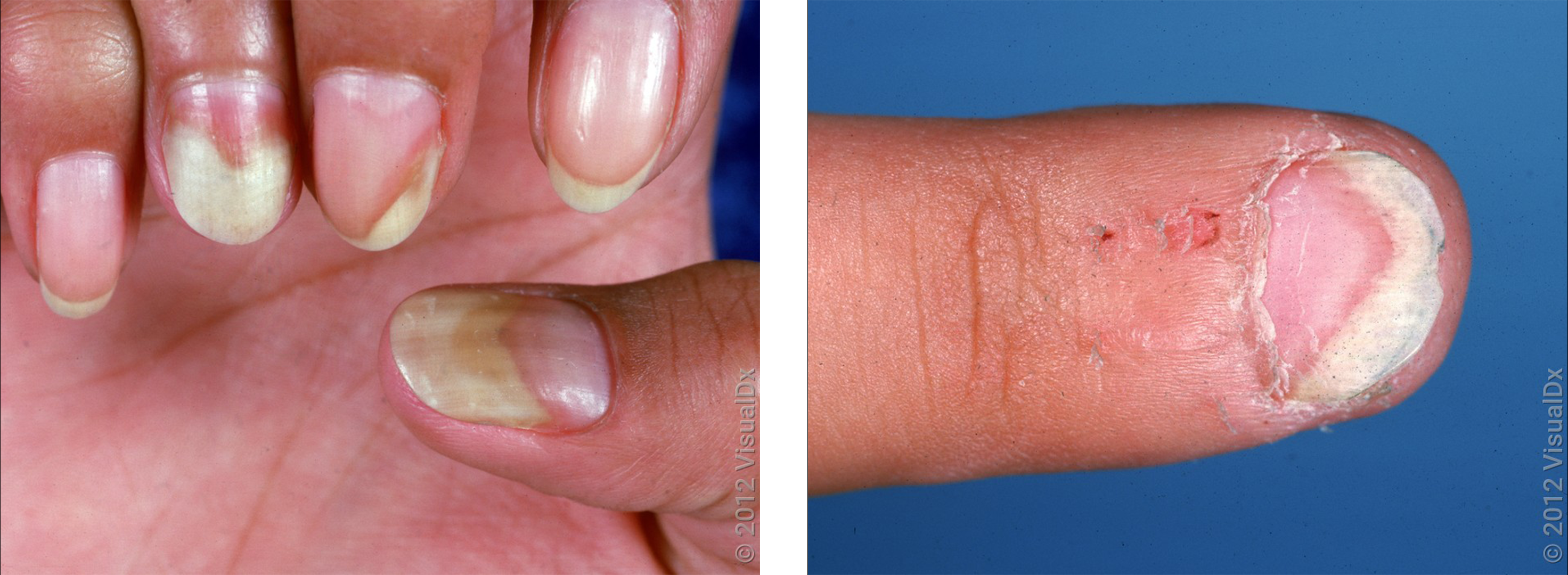 Nail Abnormalities: Causes, Symptoms, and Treatment Options