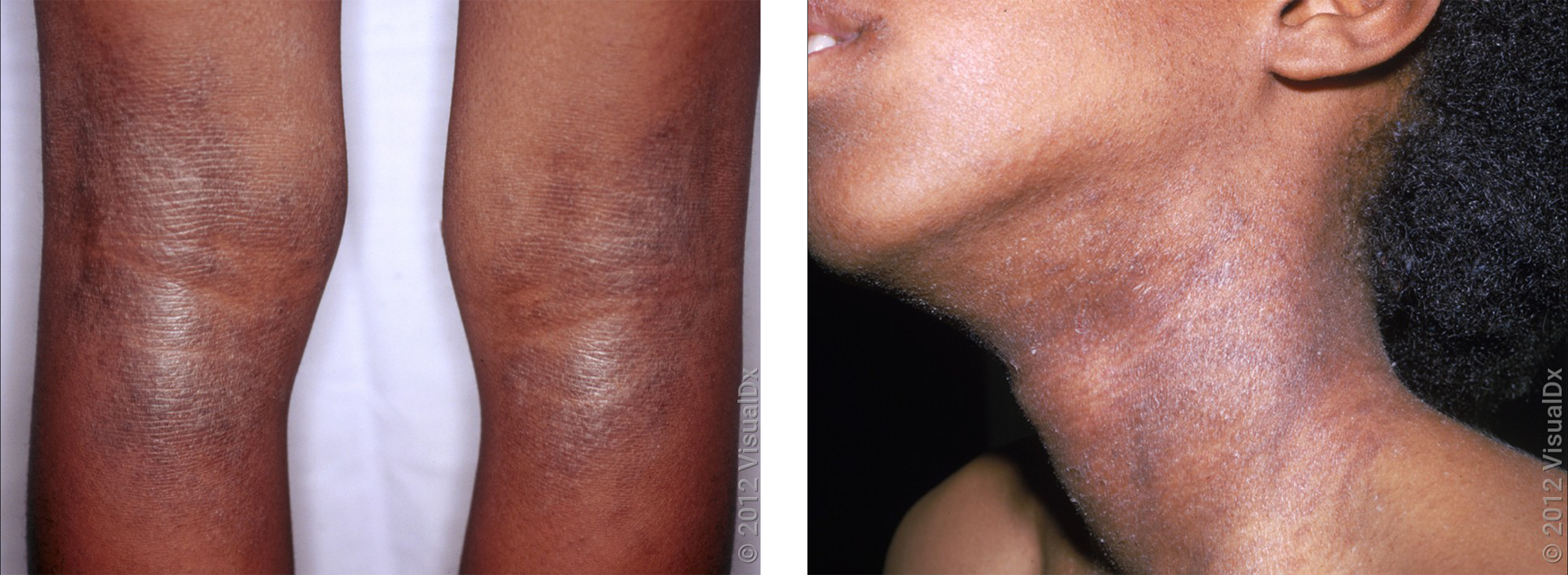 Left: Thick, violet-brown skin patches behind the knees in eczema. Right: The side of the neck with multiple small, reddish-brown bumps in eczema.
