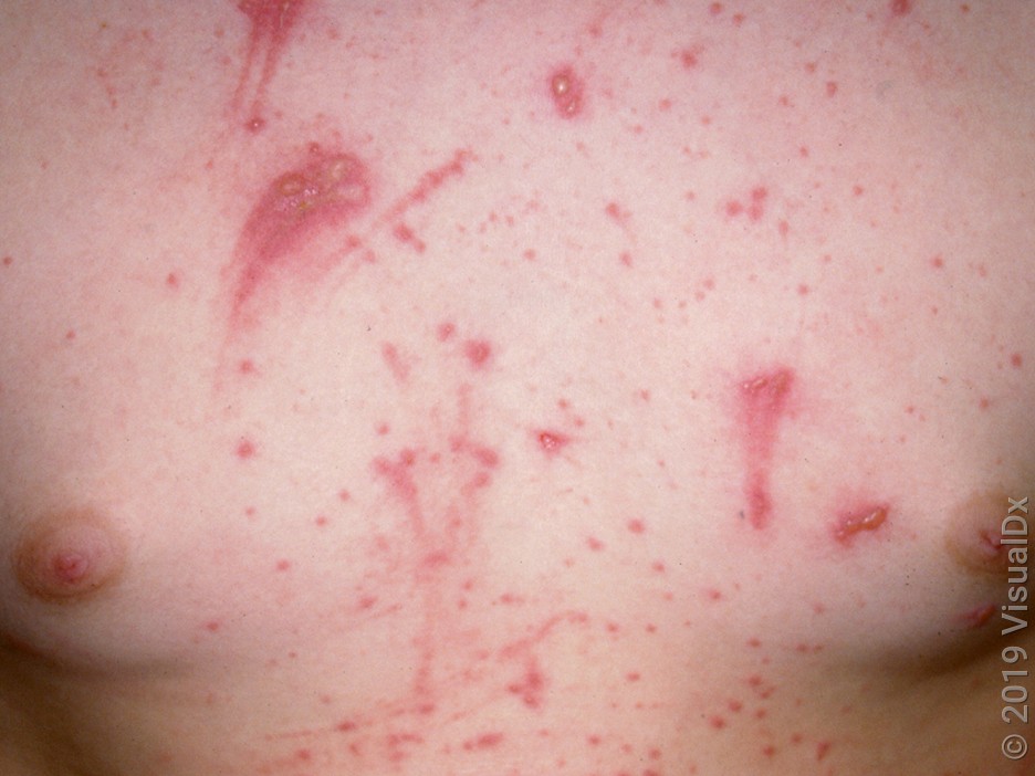 Close-up of a chest with many red bumps and blisters, some arranged as lines, in poison ivy. 