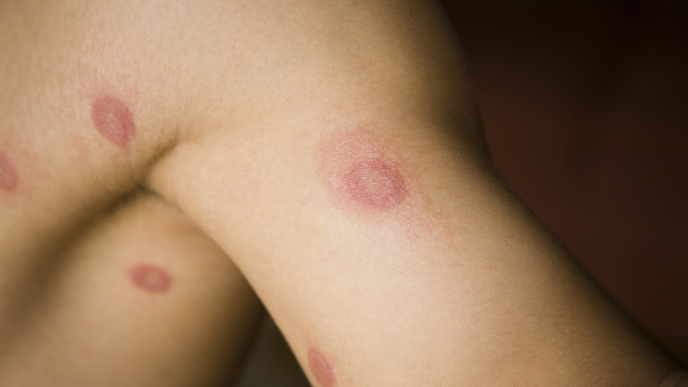 Fungal Infection on a Man S Hand. Tinea Manuum and Close-up View