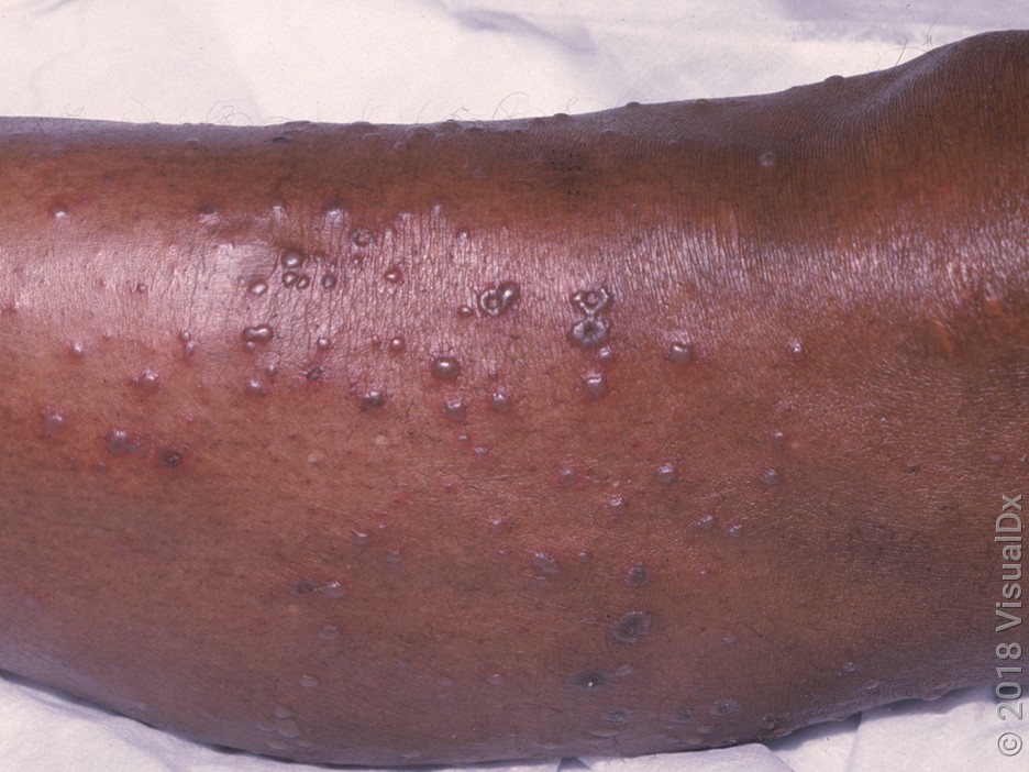 Chickenpox in Darker Skin Tones: Images and Treatment - GoodRx