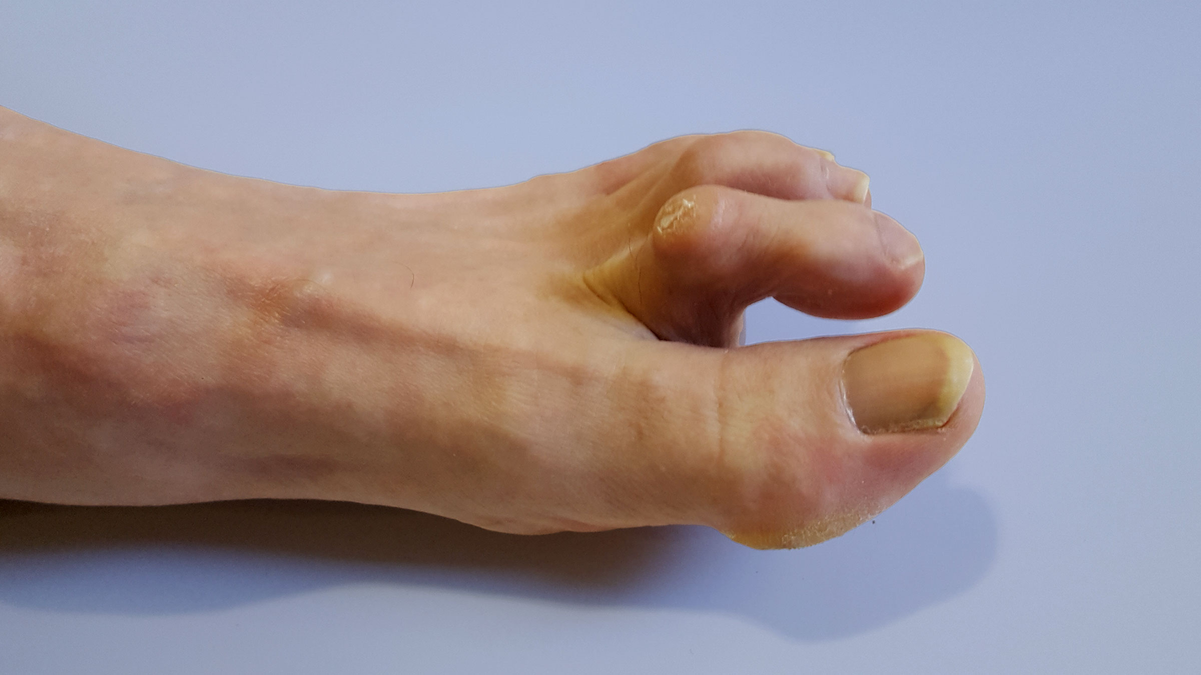 Signs and Symptoms of Claw Toes