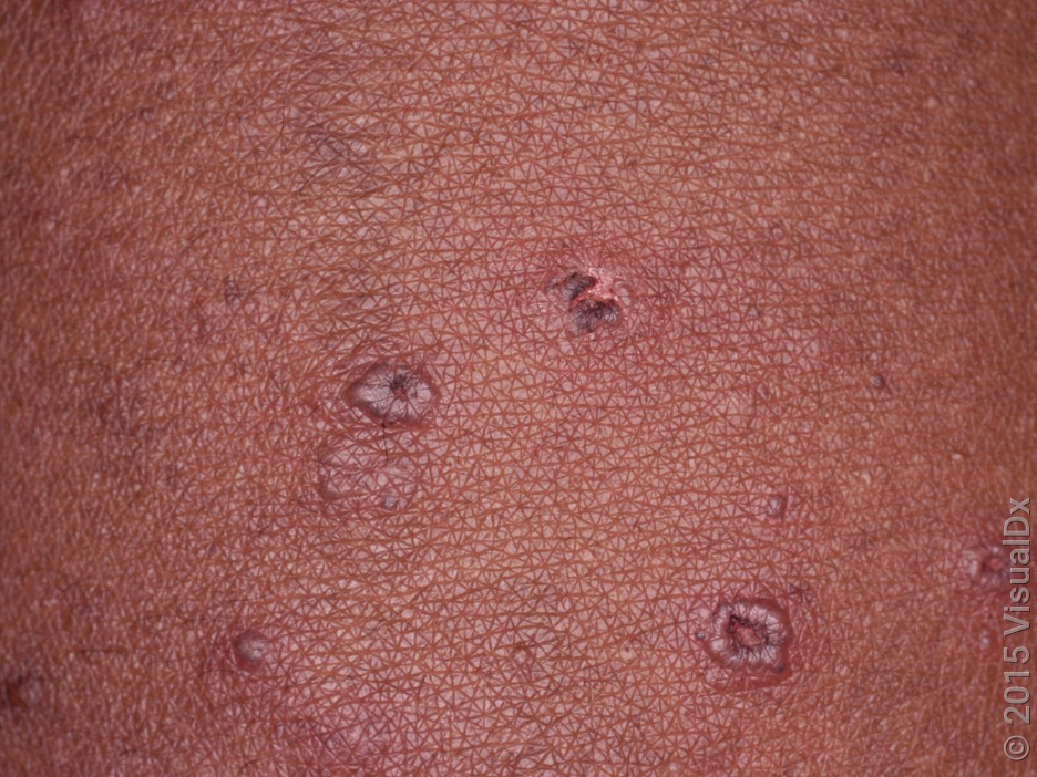 Chickenpox scabs on darker skin tone. 