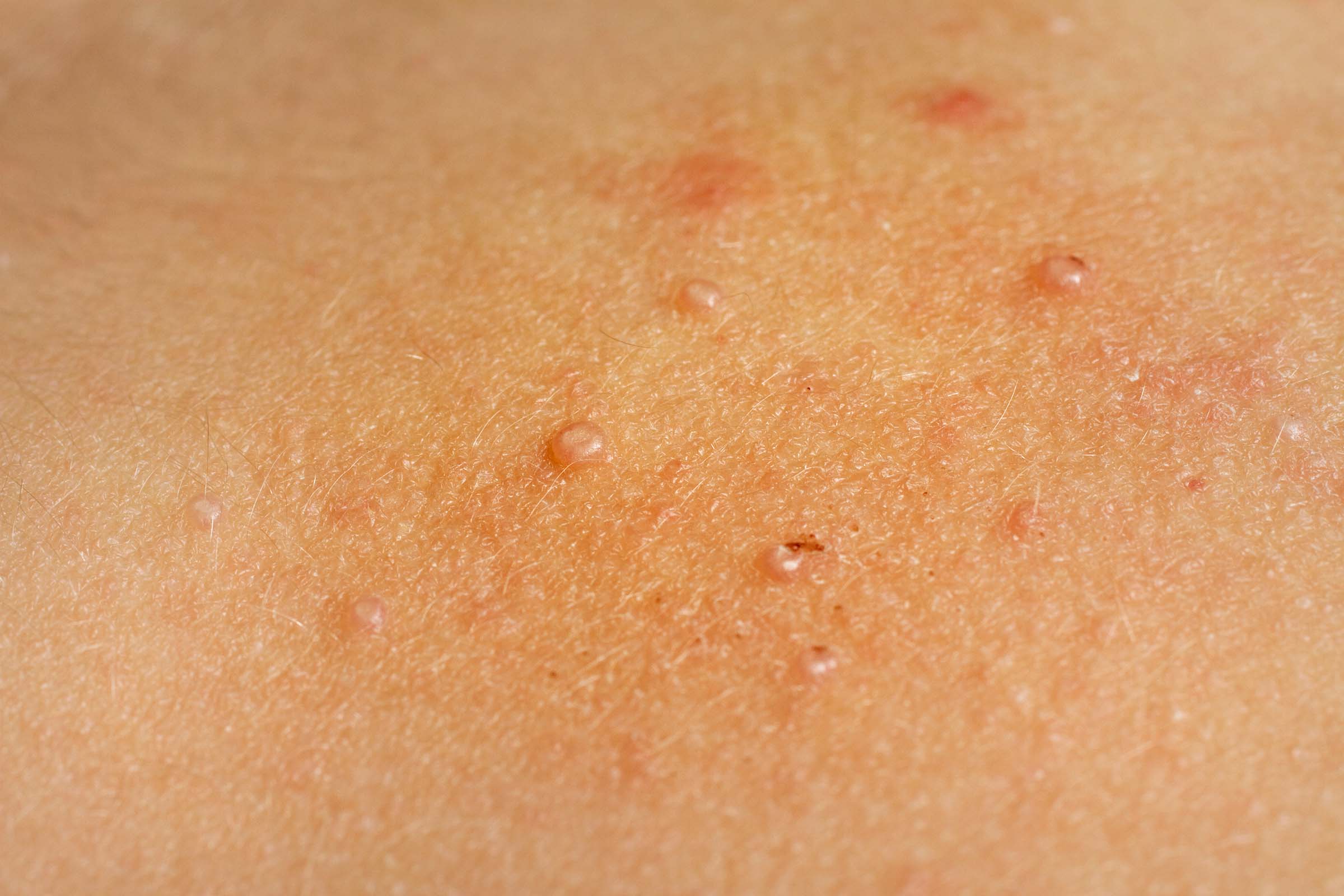 Swollen Blisters On The Skin Caused By Mosquito Bites At Thigh Stock Photo  - Download Image Now - iStock
