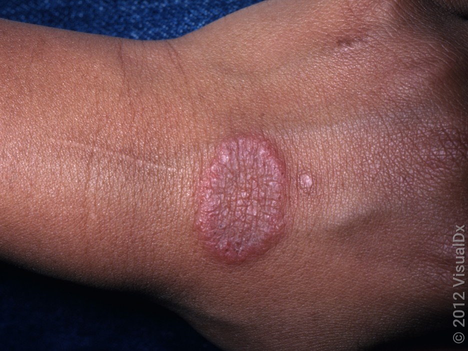 Ringworm vs. Eczema: Telling the Difference (With Pictures) - GoodRx