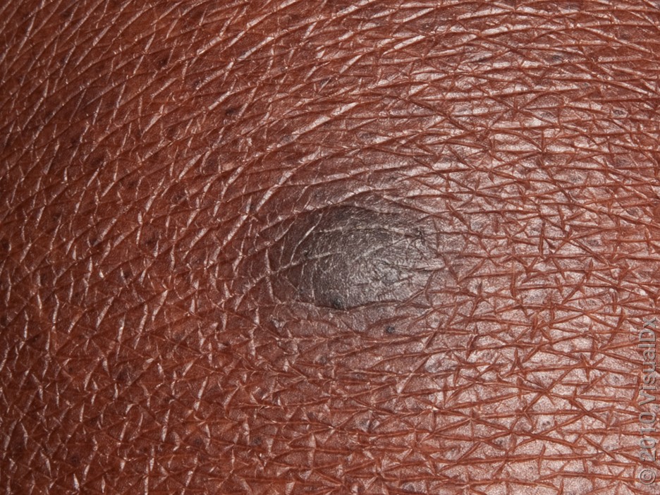 A dark dermatofibroma on the arm.