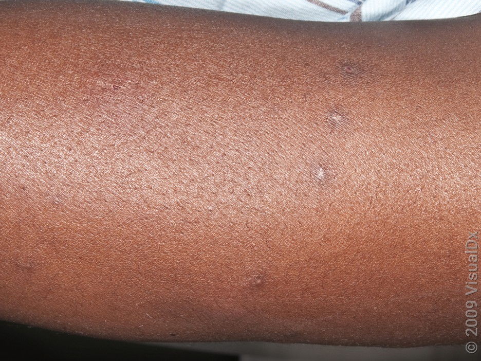 Small brown bedbug bites arranged in a line on darker skin.