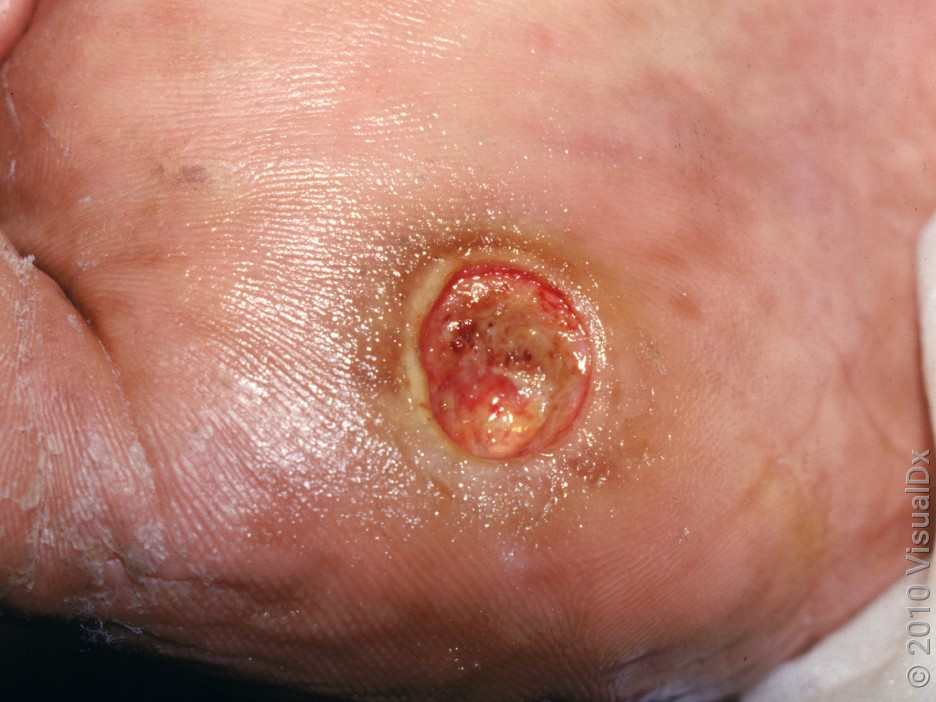 A diabetic foot sore. 
