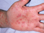Early Stevens Johnson Syndrome