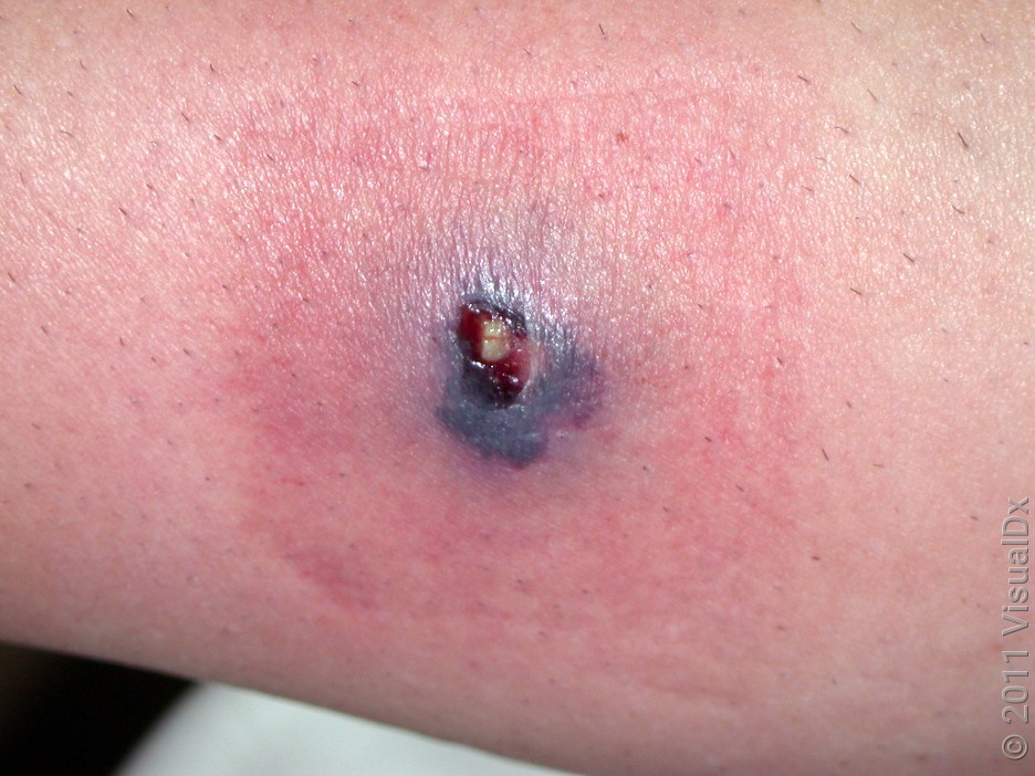 Close-up of skin with a crusty purple wound surrounded by a red patch from a spider bite.