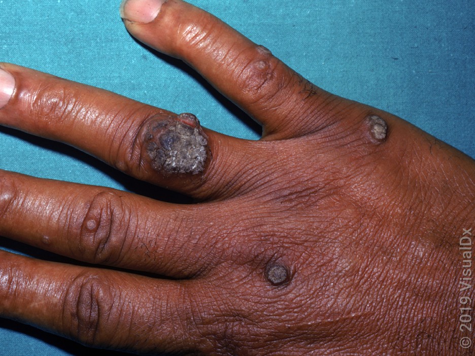 Several common warts of different sizes on the back of the hand.