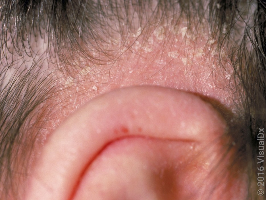 Close-up of dandruff flakes around the hairline.