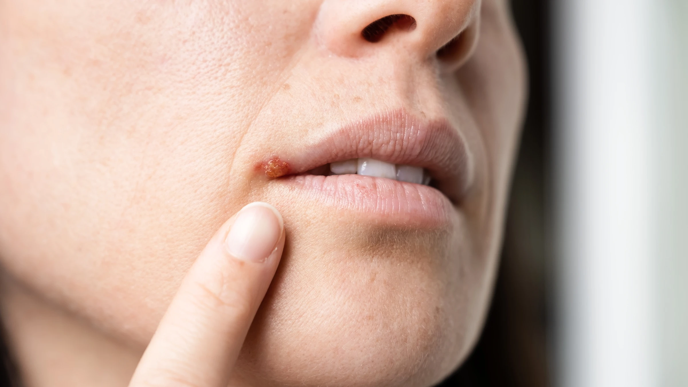 l carnitine cold sores Does Lysine Work for Cold Sores? Here's What Studies Say