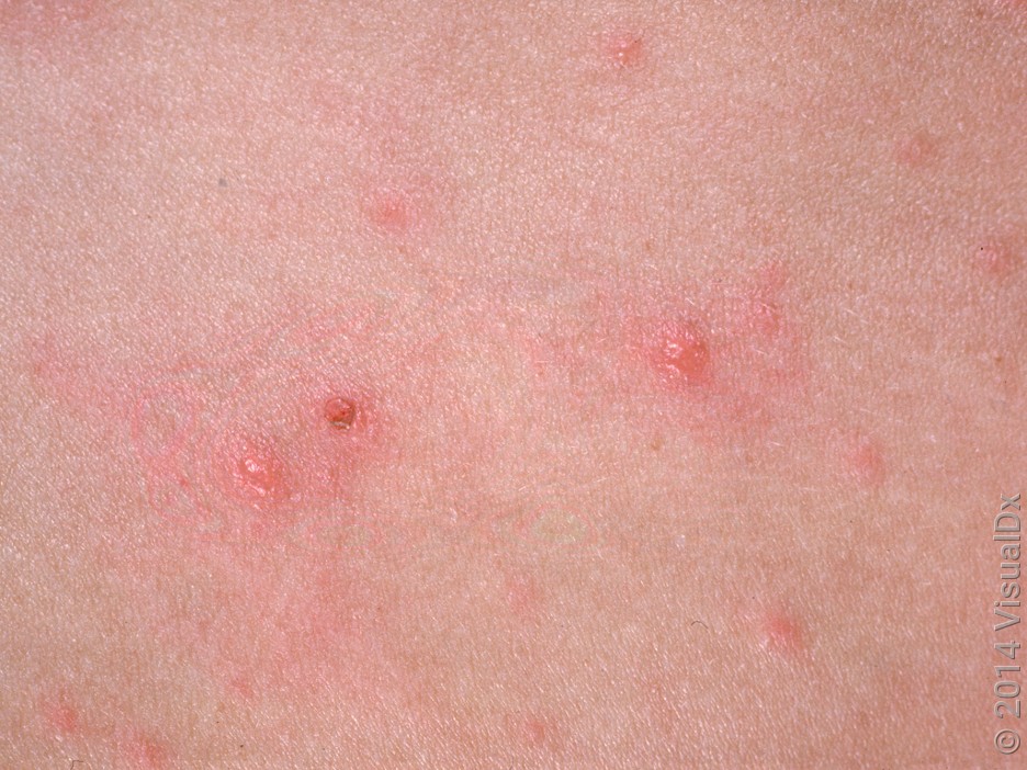 Chickenpox scab on fair skin. 