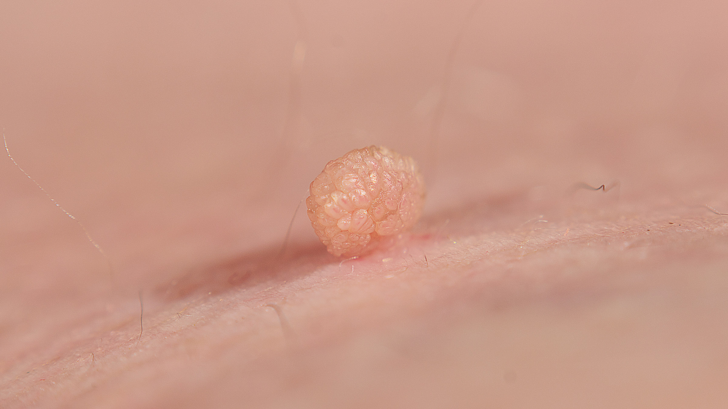 What Are Skin Tags, and How Are Skin Tags Removed? - GoodRx