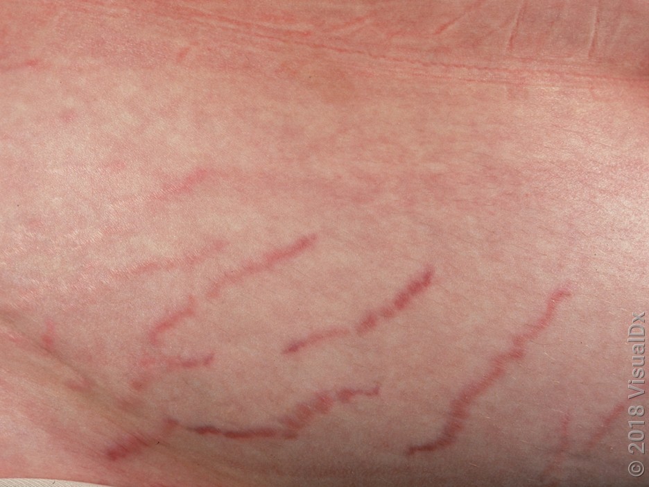Close-up look of early stretch marks.
