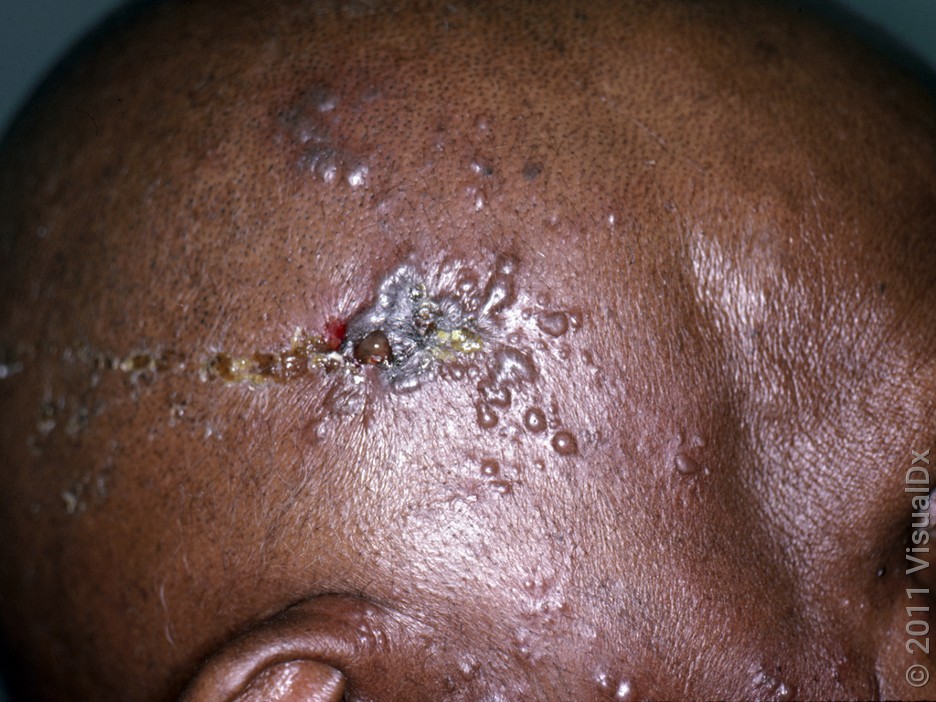 Close-up of shingles on the side of the head. 