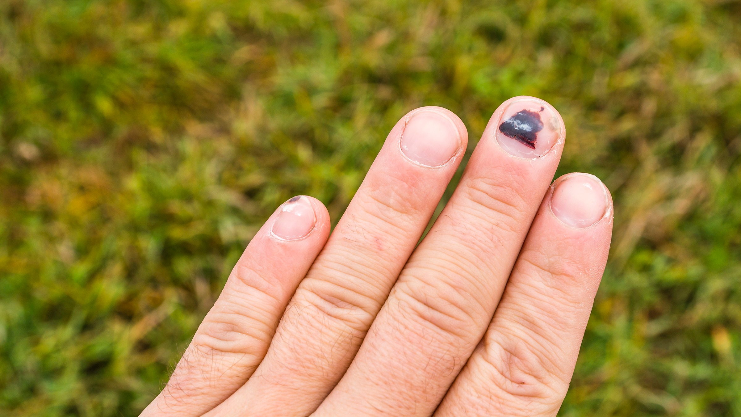 15 Fingernail and Toenail Abnormalities