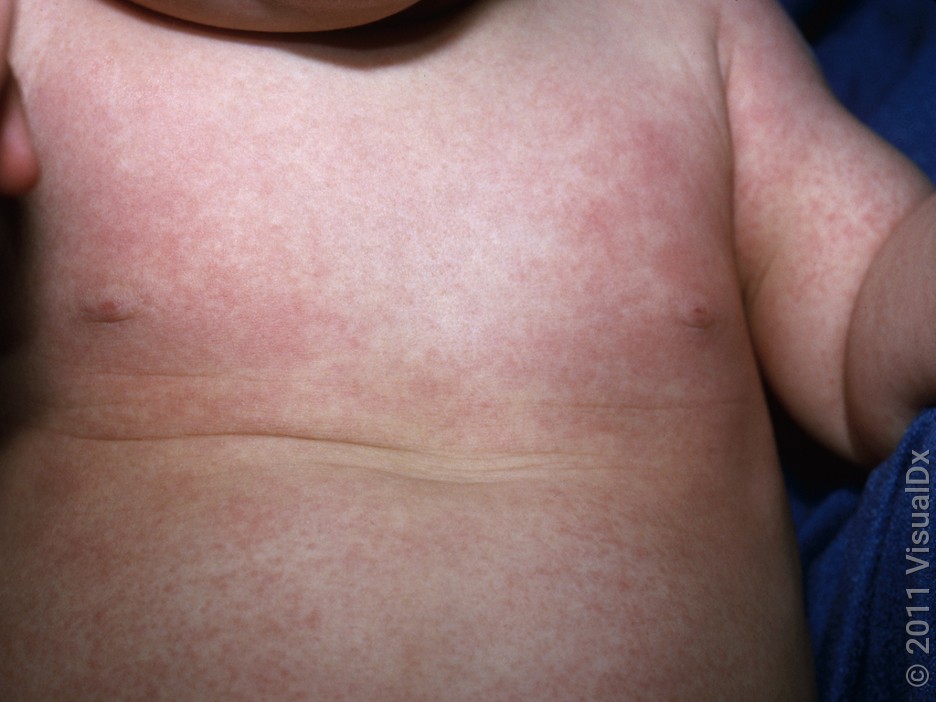 Pink patches on the torso and arms in roseola.