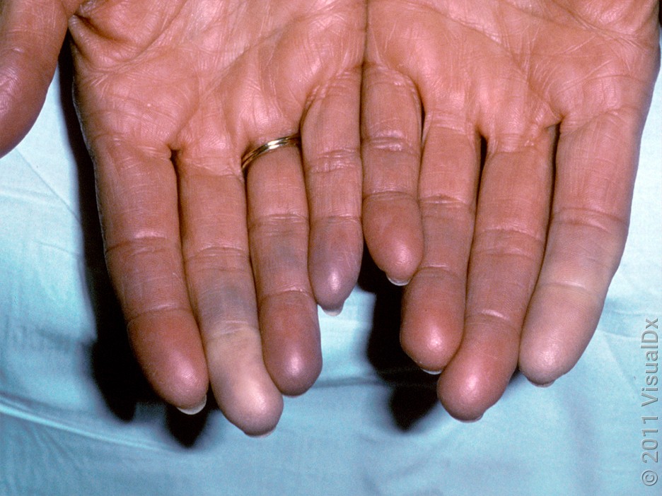 Close-up of Raynaud’s syndrome where fingers turn white and blue. 