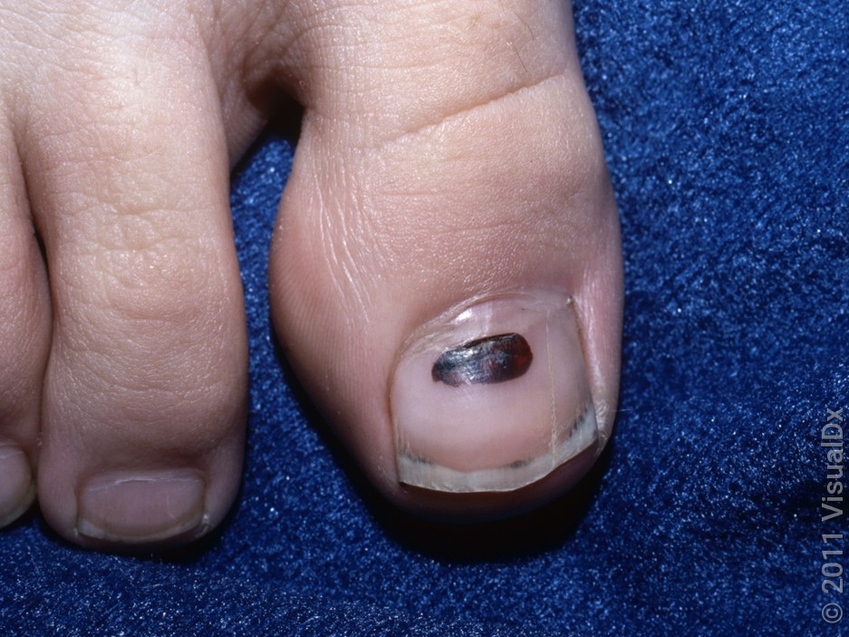 Subungual Hematoma (Blood Under Nail): Causes, Treatment - GoodRx