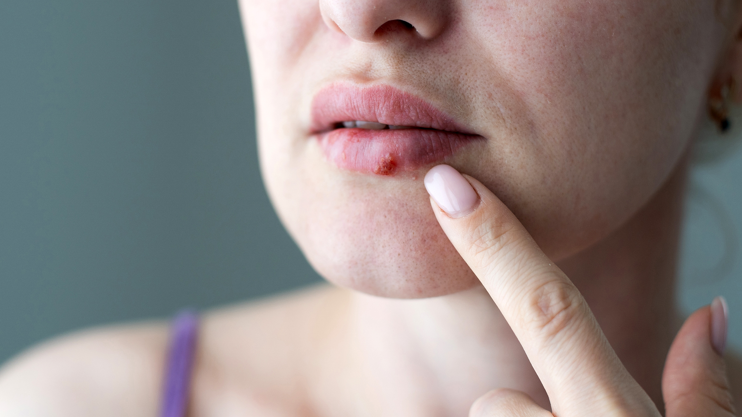 How Long Are Cold Sores Contagious? - GoodRx