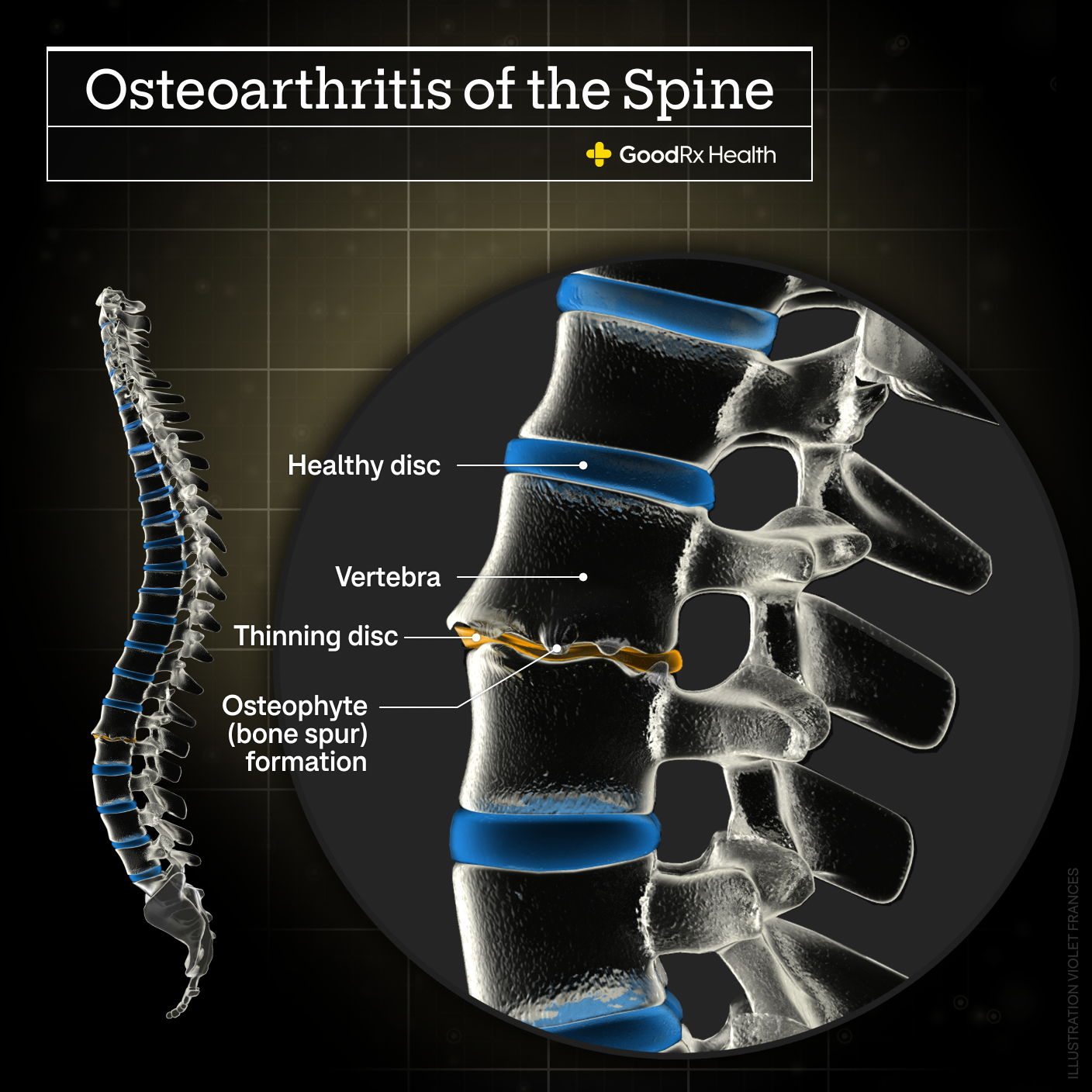 A 3D illustration of a spine with osteoarthritis including healthy disc, vertebra, thinning disc, and osteophyte (bone spur) formation. 
