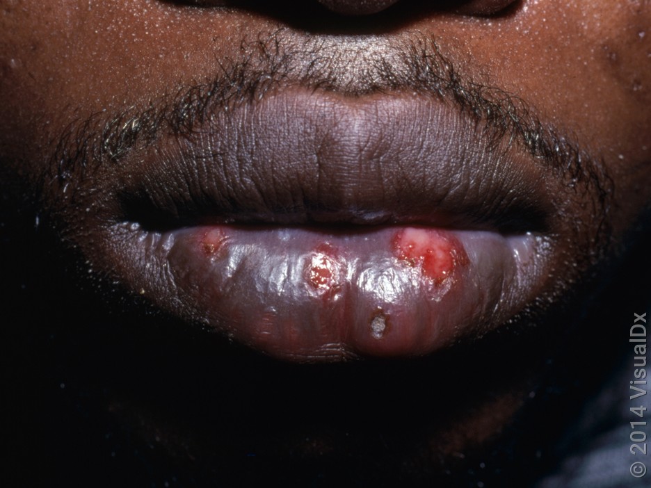Blisters break open before starting to crust over.
