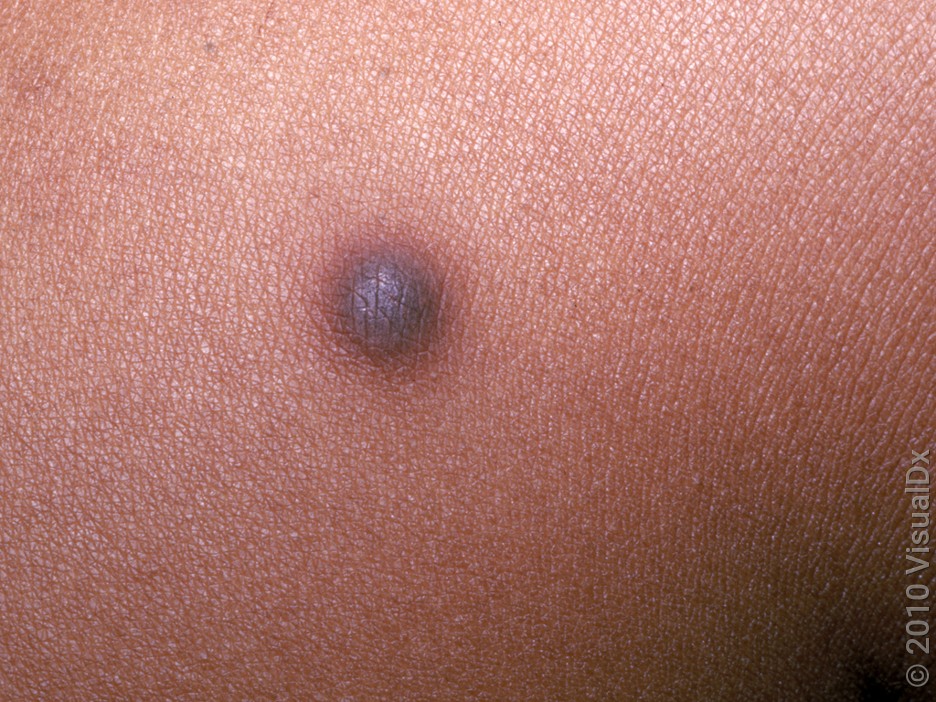 A dermatofibroma with a purple and brown color on darker skin.