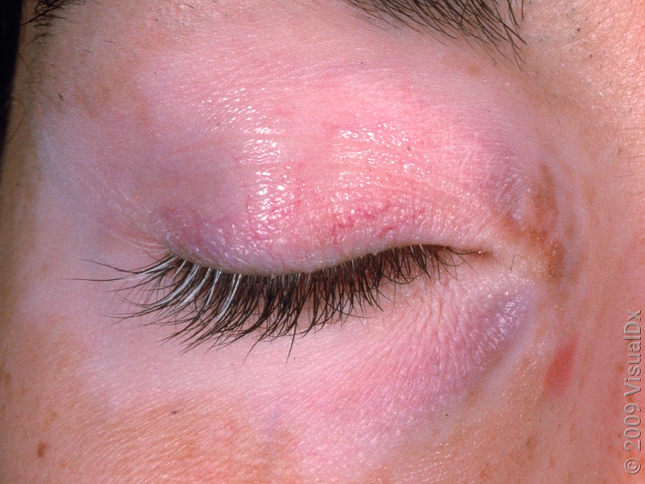 A close-up look of vitiligo around the eye. 