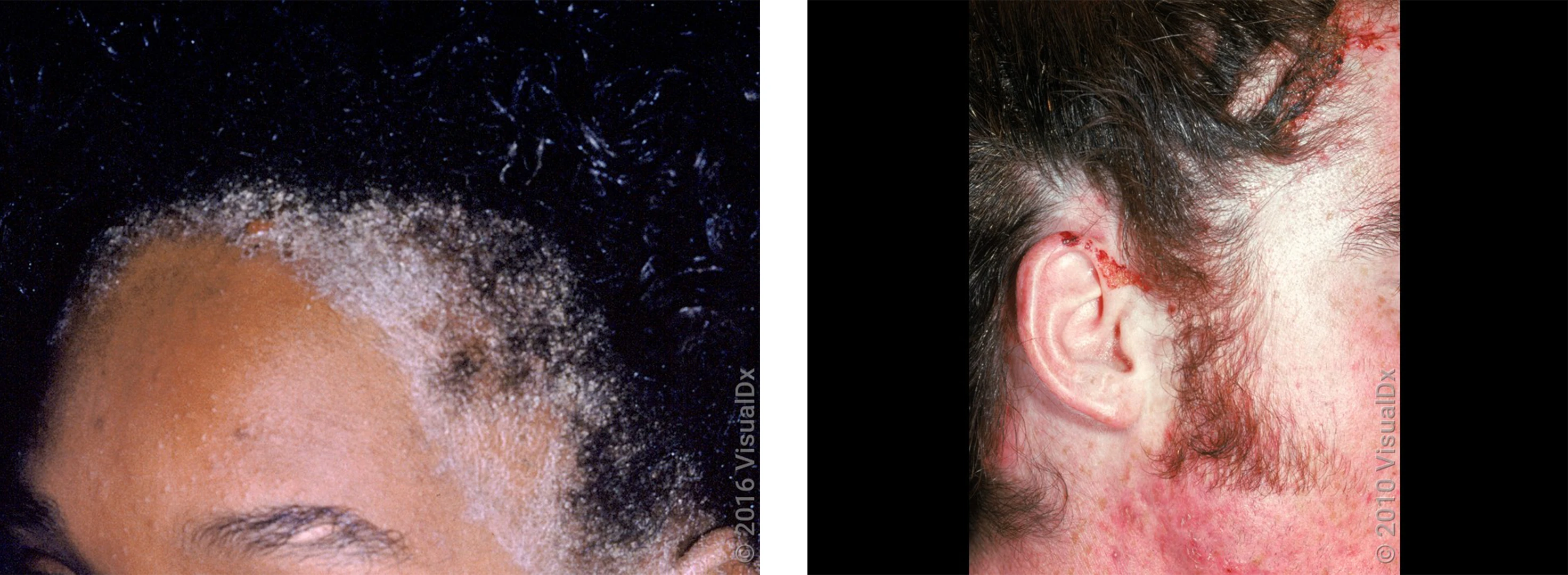 Left: Close-up of a frontal hairline with thick, white scale on the forehead going into the scalp. Right:  The side of a man’s face with a red and oozing rash in the beard and hairline.