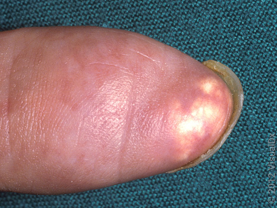 Gout Stages in Pictures - GoodRx