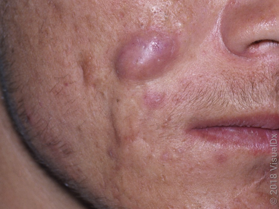 Close-up of a large acne cyst on the cheek. 