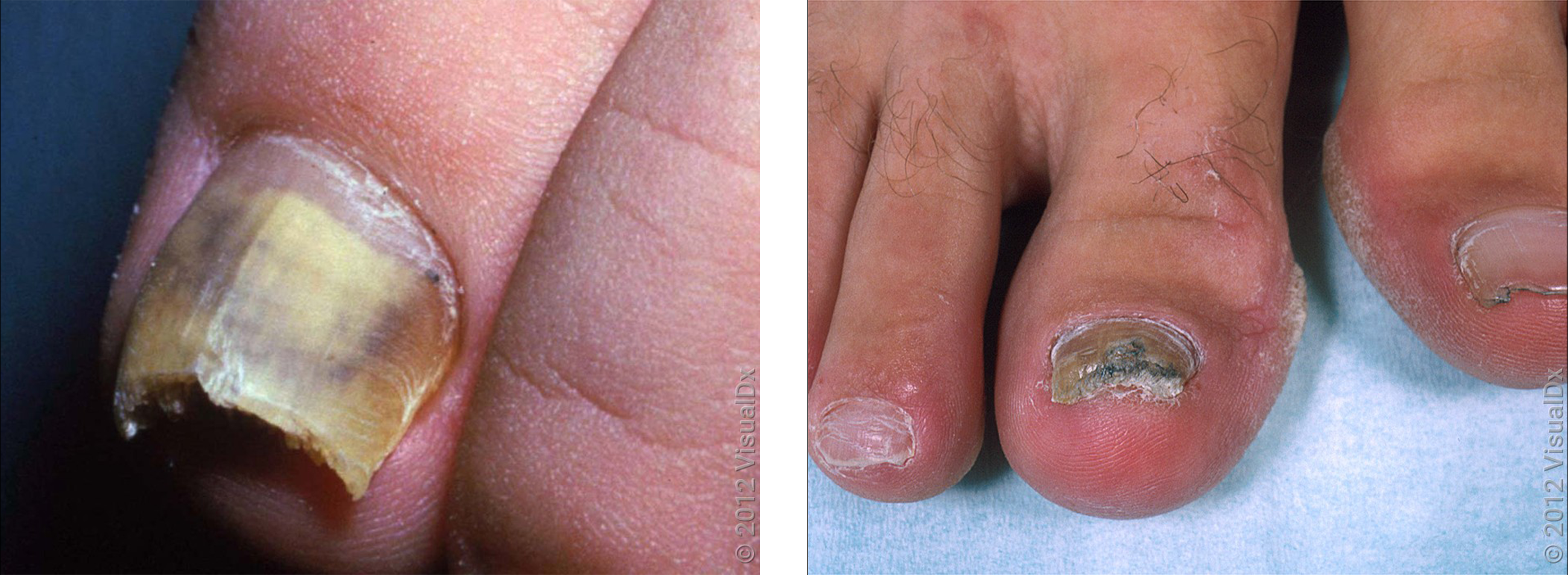 All You Need To Know About Fungal Nails