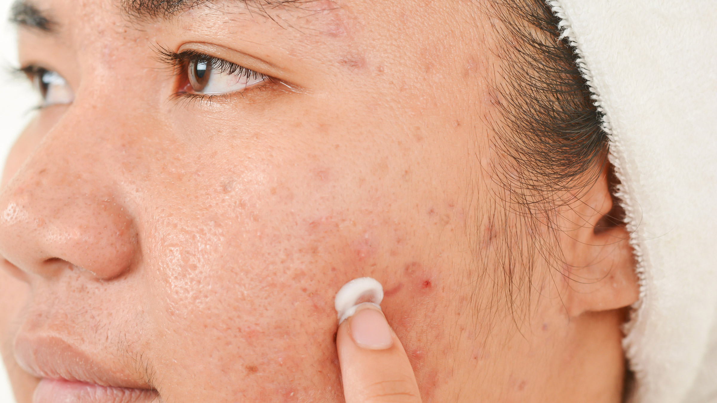 What is Tretinoin and How Can I Get It? - GoodRx