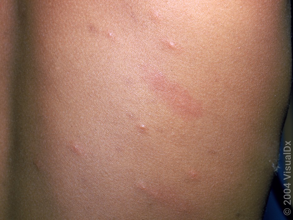 Chickenpox vs. Bug Bites: How to Tell the Difference - GoodRx