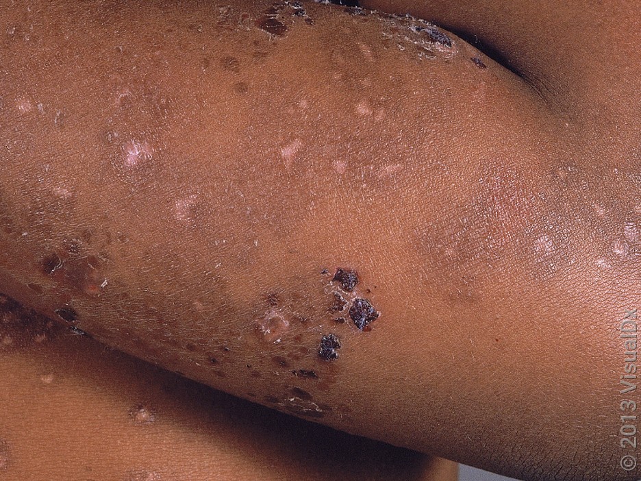 11 Common Rashes on Kids and Preschoolers (With Images) - GoodRx