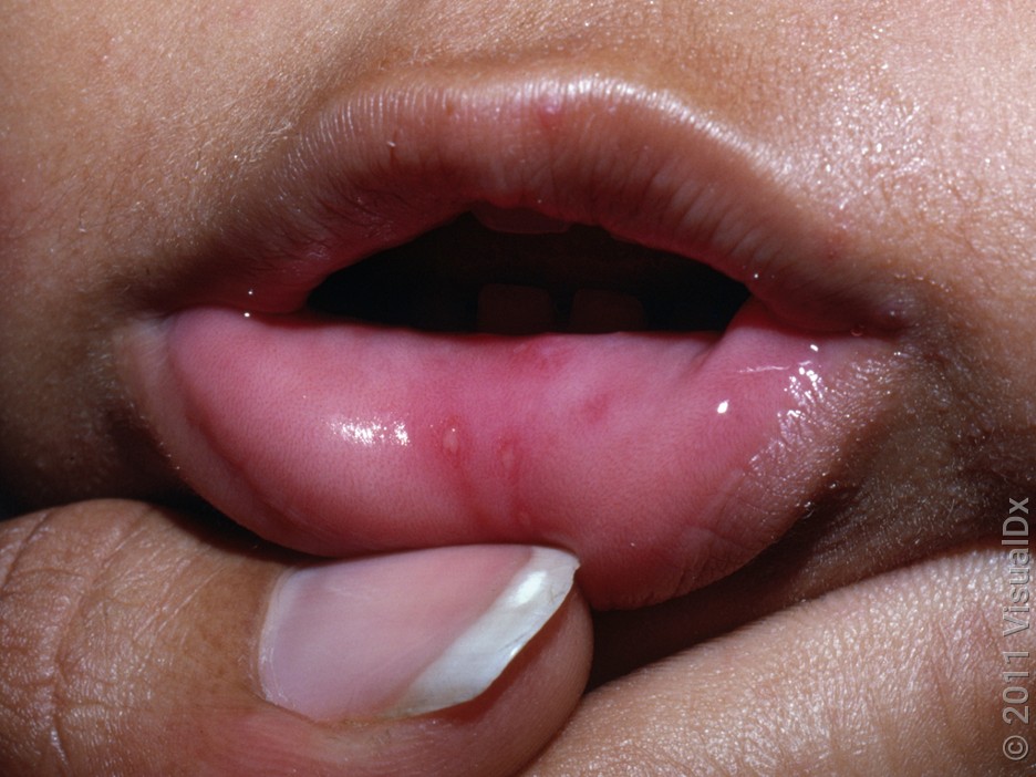 Close-up of an infant’s mouth with tiny sores on the inside of the lower lip in hand, foot, and mouth disease. 