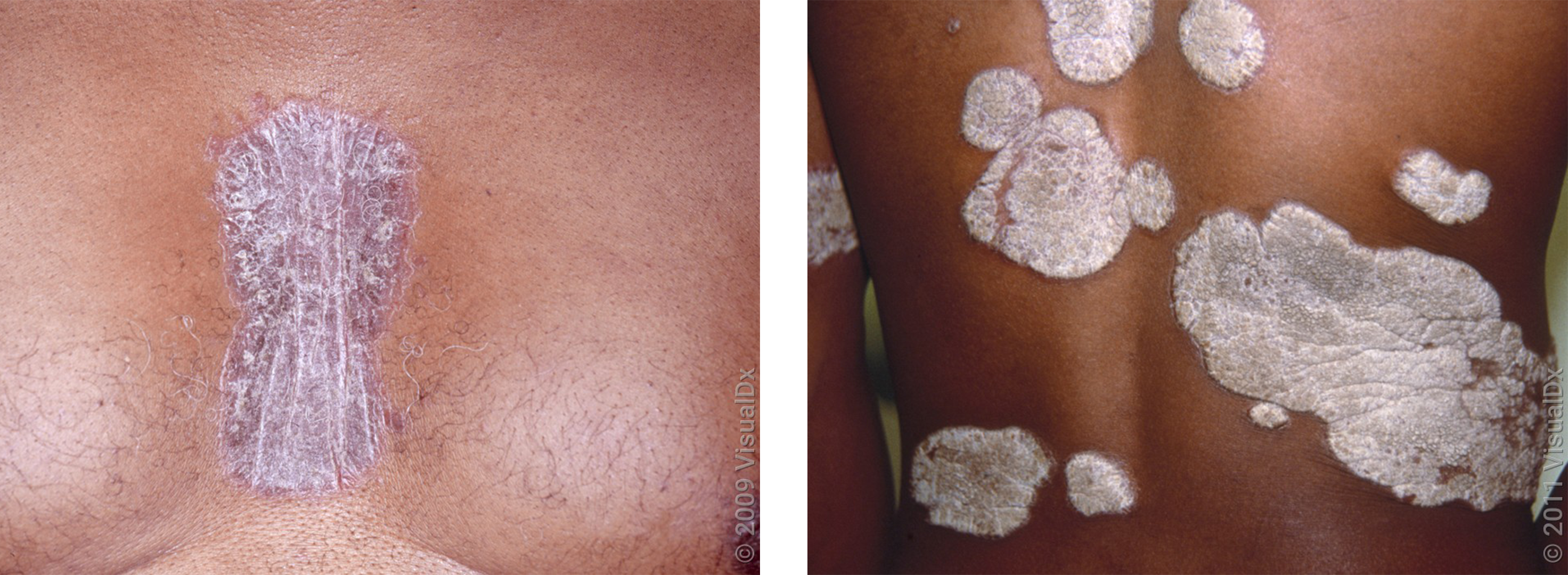 Left: Close up of a darker-skinned chest with a violet patch of skin covered in silver scale (psoriasis).  Right: The back of a person with dark skin showing large, thick white patches (psoriasis). 