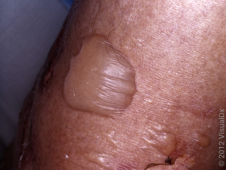 A large fluid-filled blister with two smaller blisters on the skin.