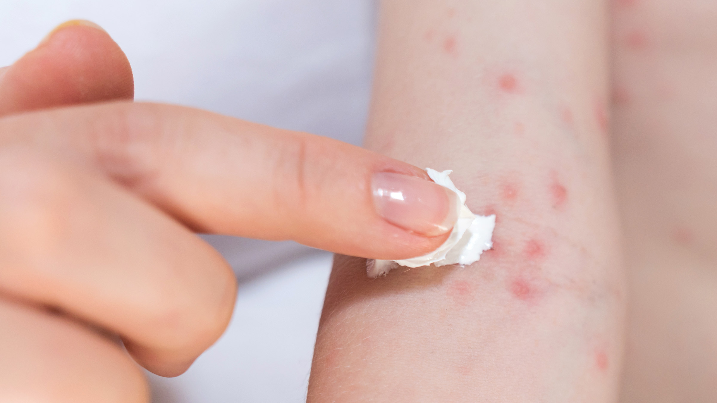 What are Hives? | Symptoms of Hives | LloydsPharmacy